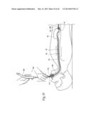 SYSTEMS AND METHODS FOR TREATING OBESITY AND OTHER GASTROINTESTINAL     CONDITIONS diagram and image