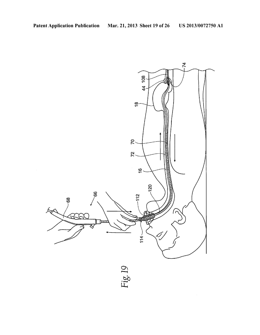 SYSTEMS AND METHODS FOR TREATING OBESITY AND OTHER GASTROINTESTINAL     CONDITIONS - diagram, schematic, and image 20