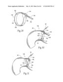 SYSTEMS AND METHODS FOR TREATING OBESITY AND OTHER GASTROINTESTINAL     CONDITIONS diagram and image