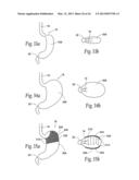 SYSTEMS AND METHODS FOR TREATING OBESITY AND OTHER GASTROINTESTINAL     CONDITIONS diagram and image