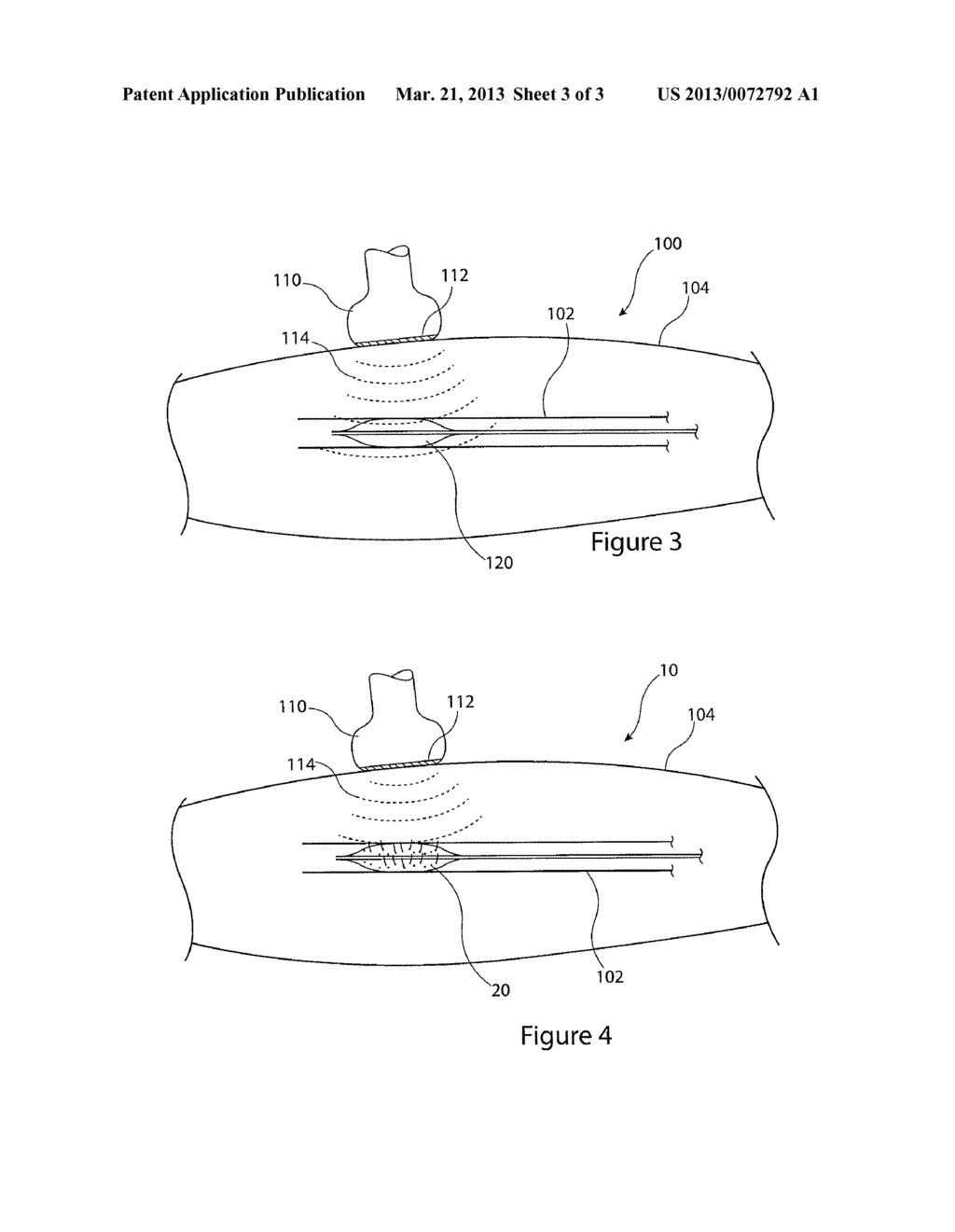 ULTRASONICALLY VISIBLE BALLOON CATHETER ASSEMBLY AND METHOD OF IMAGING A     MEDICAL BALLOON - diagram, schematic, and image 04