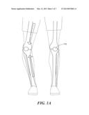 Knee Brace with Expandable Members and Method of Using the Same diagram and image