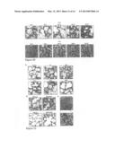 USE OF ENTRAINED NEUTROPHILS TO TREAT METASTATIC AND MICROMETASTATIC     DISEASE IN AT RISK PATIENTS diagram and image