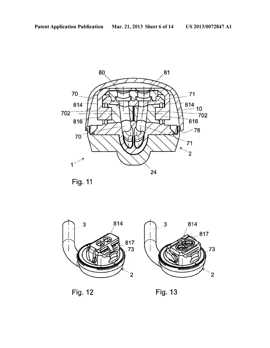 IMPLANTED ACCESS PORT - diagram, schematic, and image 07