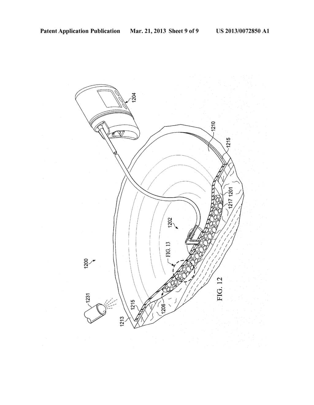 TISSUE TREATMENT SYSTEMS AND METHODS HAVING A     NON-TACTILE-STIMULUS-ACTIVATED, MACROSCOPICALLY-DEFORMING MATERIAL - diagram, schematic, and image 10