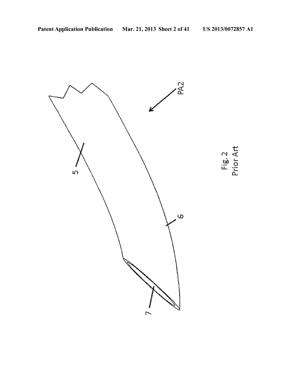 MEDICAL TOOL FOR REDUCED PENETRATION FORCE WITH FEEDBACK MEANS - diagram, schematic, and image 03