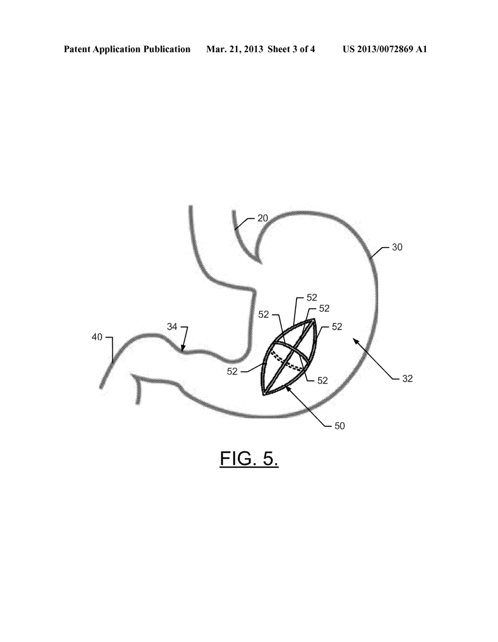 Intra-Gastric Timed-Release Drug Delivery System - diagram, schematic, and image 04