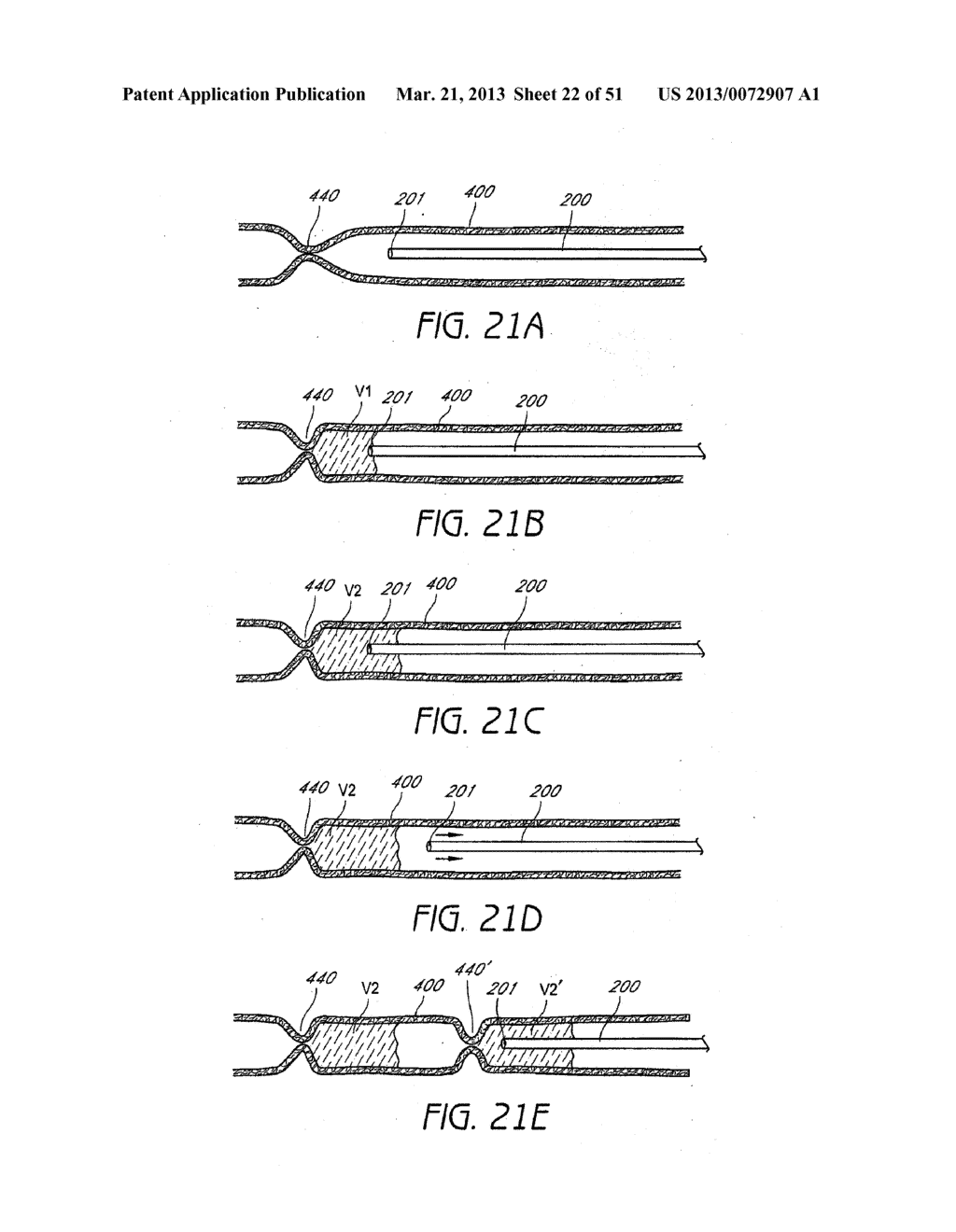 ENHANCED ULTRASOUND VISUALIZATION OF INTRAVASCULAR DEVICES - diagram, schematic, and image 23