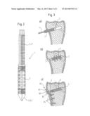 BONE SCREW AND BONE SCREW WITH HOLDING ELEMENT diagram and image