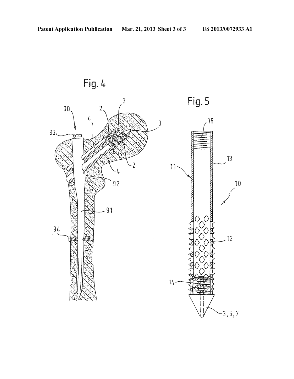 BONE SCREW AND BONE SCREW WITH HOLDING ELEMENT - diagram, schematic, and image 04