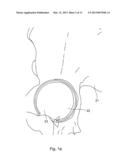 POSITION OF HIP JOINT PROSTHESES diagram and image