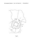 POSITION OF HIP JOINT PROSTHESES diagram and image