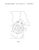 POSITION OF HIP JOINT PROSTHESES diagram and image