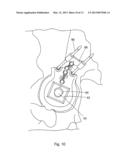 POSITION OF HIP JOINT PROSTHESES diagram and image