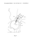 POSITION OF HIP JOINT PROSTHESES diagram and image