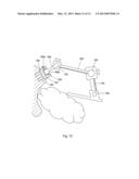 POSITION OF HIP JOINT PROSTHESES diagram and image