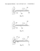 POSITION OF HIP JOINT PROSTHESES diagram and image