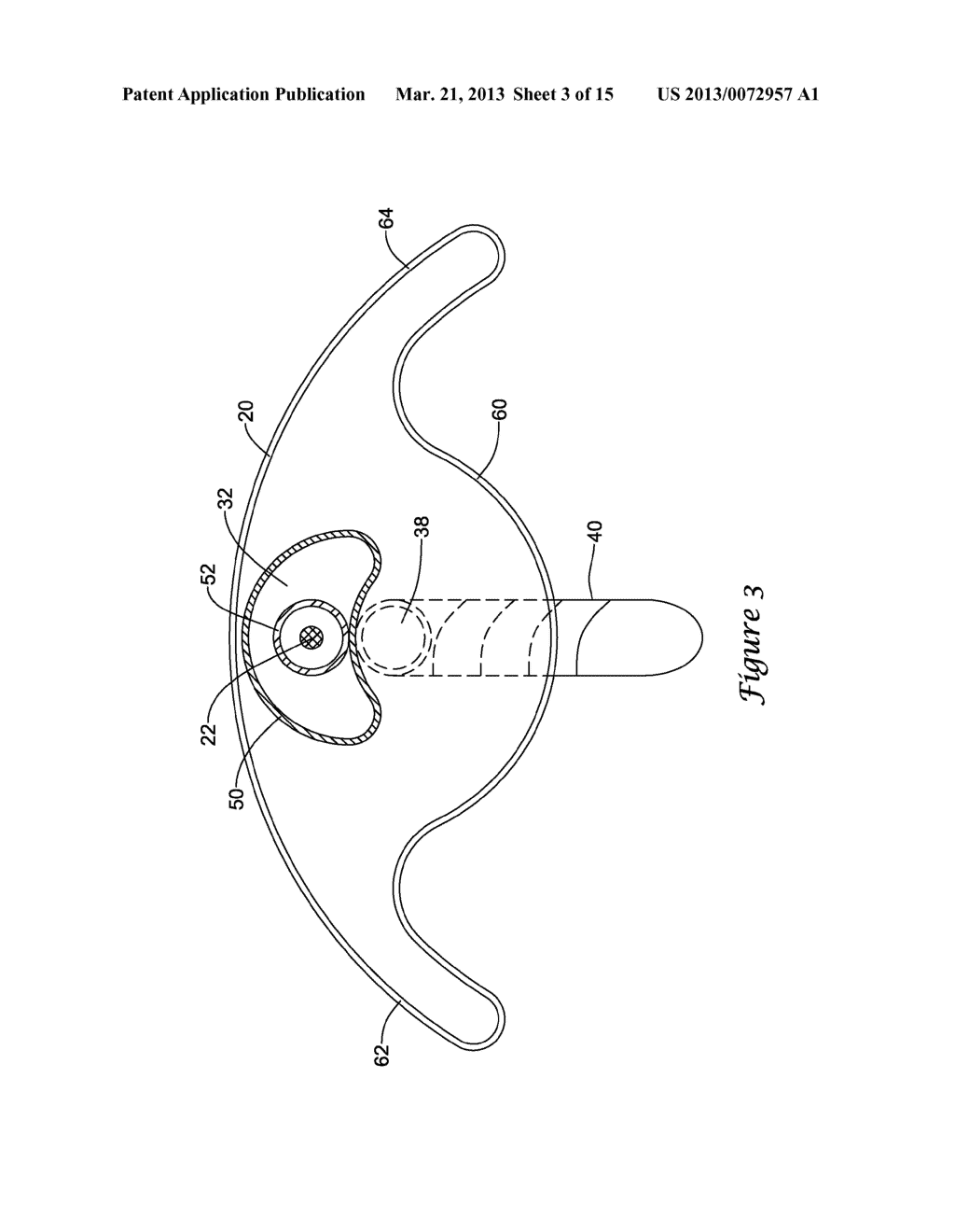 SUBINTIMAL RE-ENTRY CATHETER AND RETROGRADE RECANALIZATION - diagram, schematic, and image 04