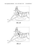 SINUS BALLOON DILATION CATHETERS AND SINUS SURGURY TOOLS diagram and image