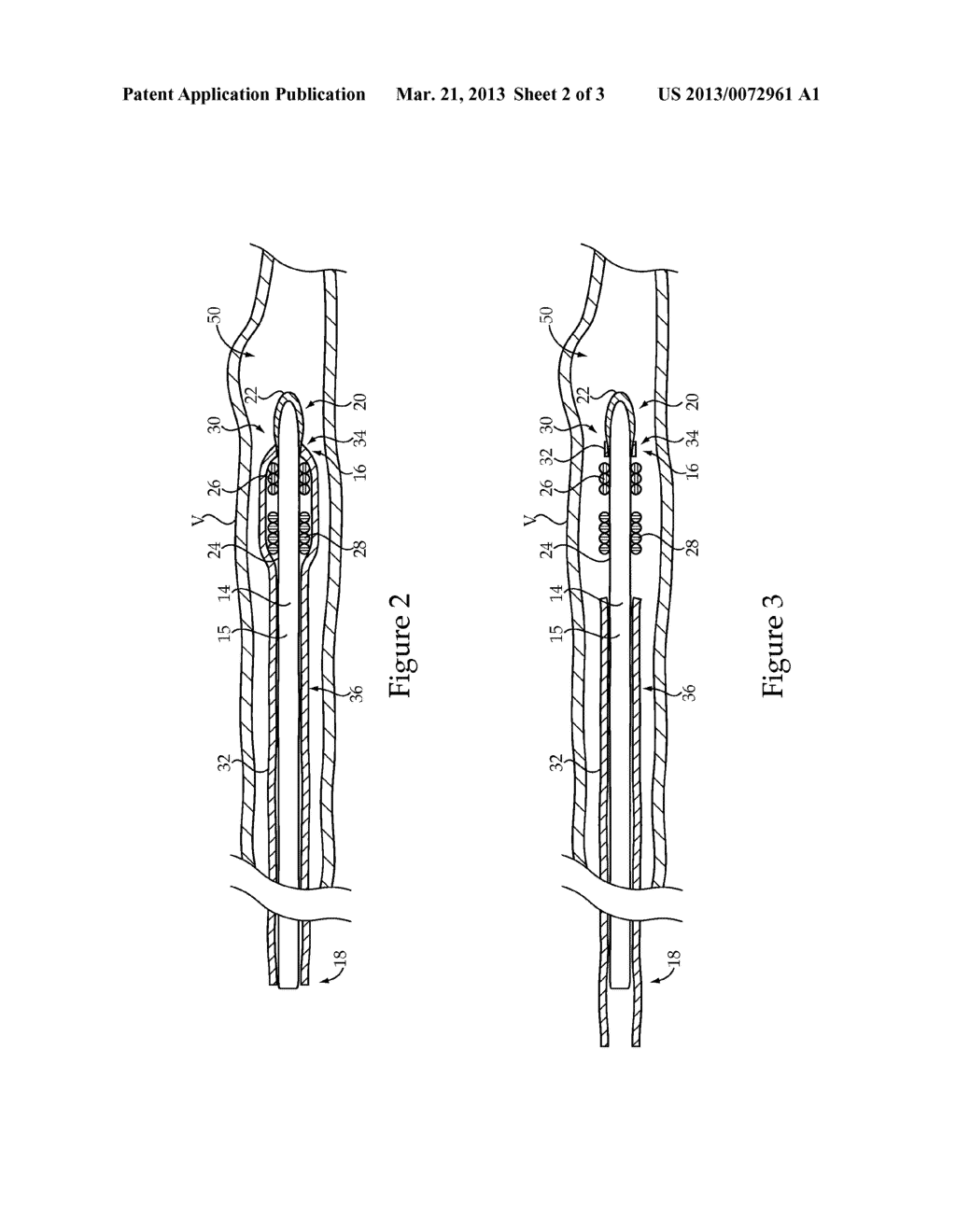 Embolic Coil Delivery System - diagram, schematic, and image 03