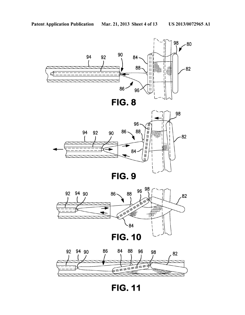 Delivery Systems and Methods for PFO Closure Device with Two Anchors - diagram, schematic, and image 05