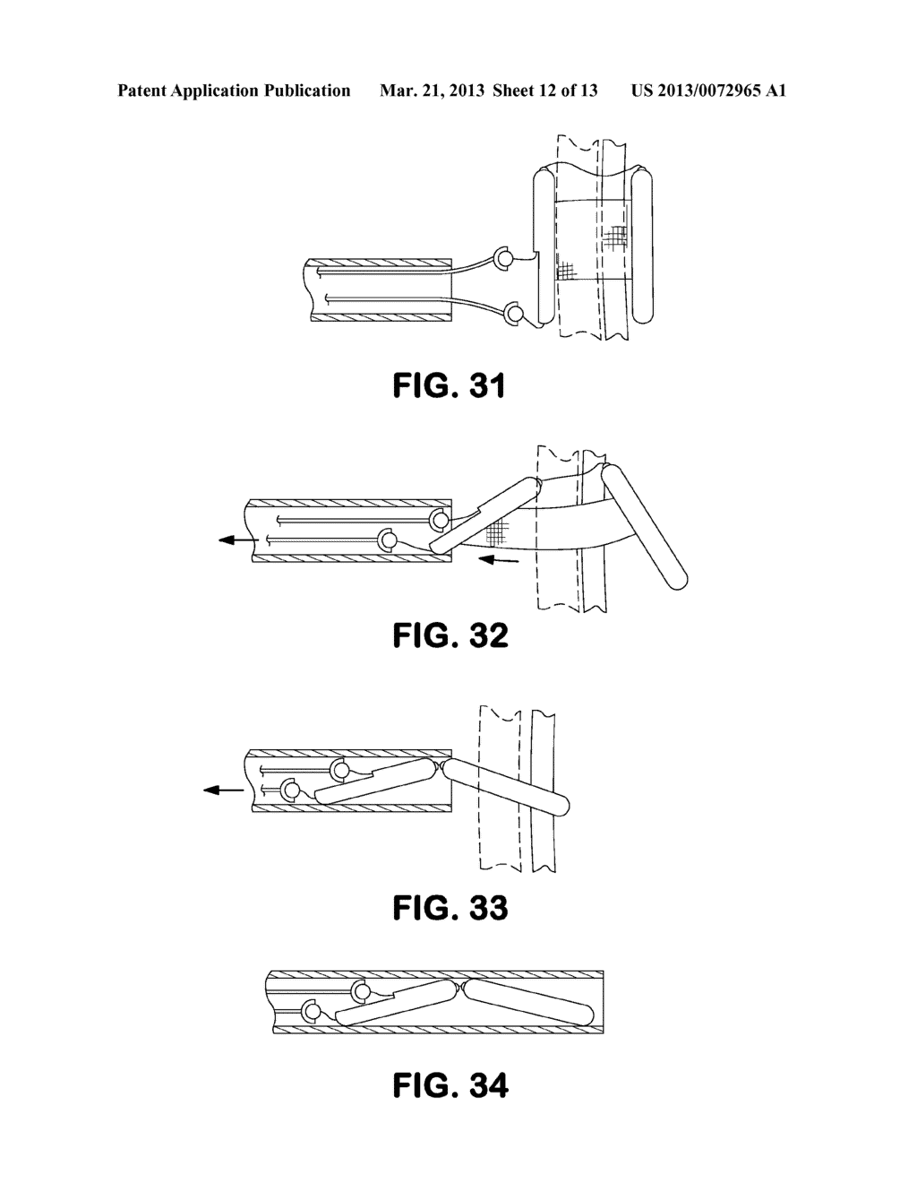 Delivery Systems and Methods for PFO Closure Device with Two Anchors - diagram, schematic, and image 13