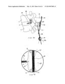 SYSTEMS AND METHODS FOR POSTERIOR DYNAMIC STABILIZATION OF THE SPINE diagram and image