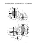 SYSTEMS AND METHODS FOR POSTERIOR DYNAMIC STABILIZATION OF THE SPINE diagram and image