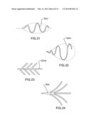 Stent diagram and image