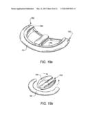 SYSTEMS AND METHODS FOR HOLDING ANNULOPLASTY RINGS diagram and image