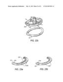 SYSTEMS AND METHODS FOR HOLDING ANNULOPLASTY RINGS diagram and image