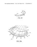 SYSTEMS AND METHODS FOR HOLDING ANNULOPLASTY RINGS diagram and image