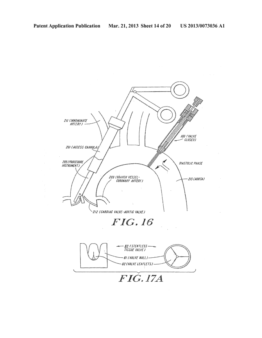 Cardiac Valve Procedure Methods and Devices - diagram, schematic, and image 15