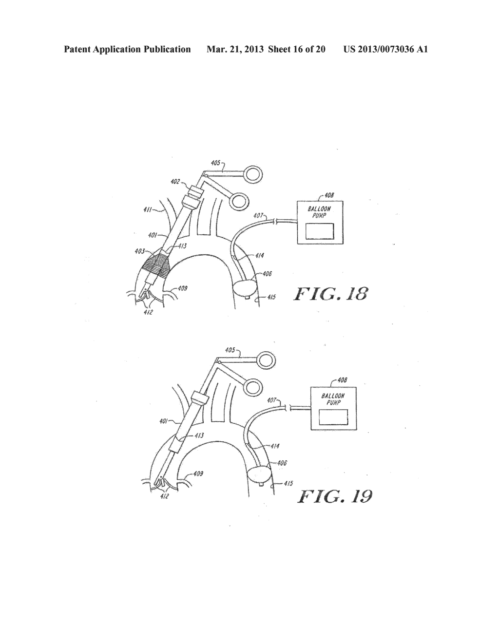 Cardiac Valve Procedure Methods and Devices - diagram, schematic, and image 17