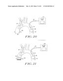 Cardiac Valve Procedure Methods and Devices diagram and image