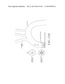 Cardiac Valve Procedure Methods and Devices diagram and image