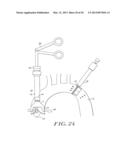 Cardiac Valve Procedure Methods and Devices diagram and image