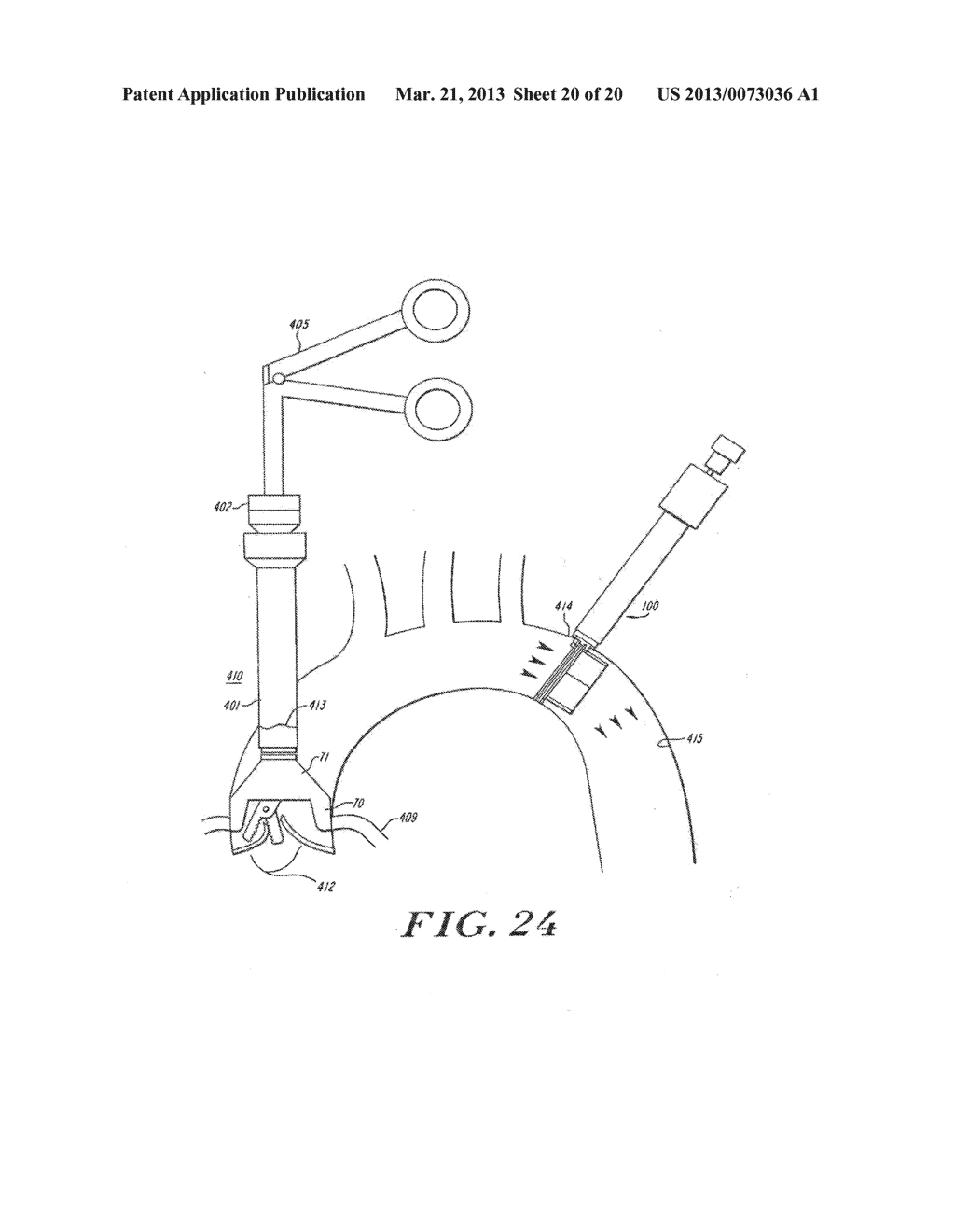 Cardiac Valve Procedure Methods and Devices - diagram, schematic, and image 21