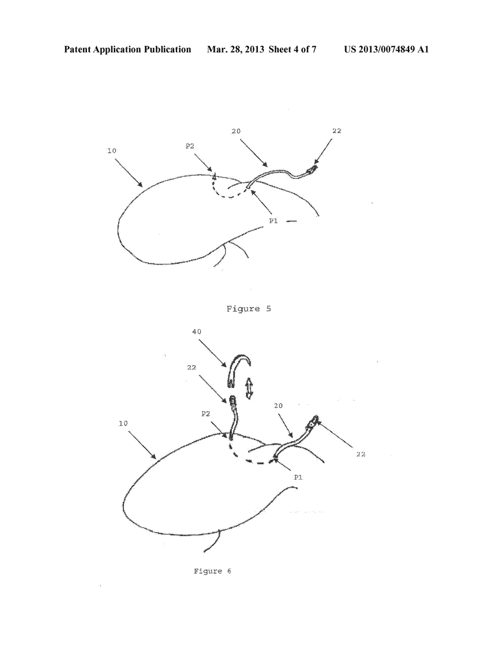 Modular Tissue Securement Systems - diagram, schematic, and image 05