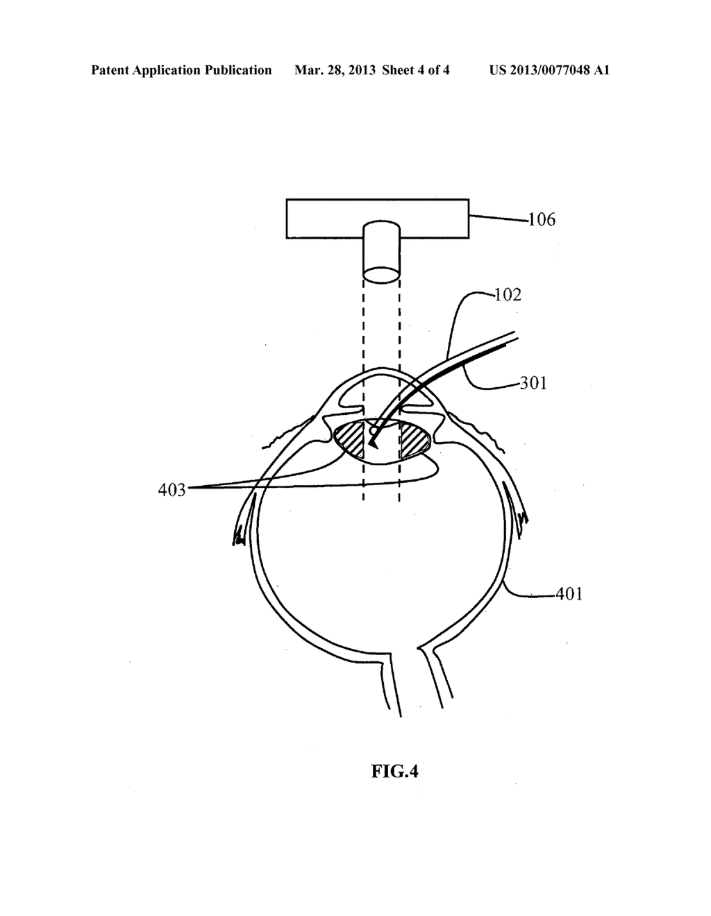 INTEGRATED FIBER OPTIC OPHTHALMIC INTRAOCULAR SURGICAL DEVICE WITH CAMERA - diagram, schematic, and image 05
