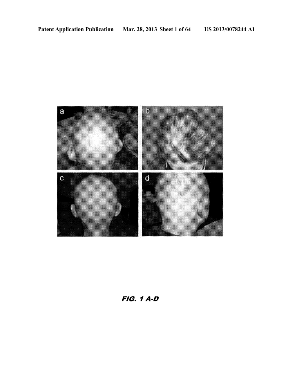 METHODS FOR DETECTING AND REGULATING ALOPECIA AREATA  AND GENE COHORTS     THEREOF - diagram, schematic, and image 02