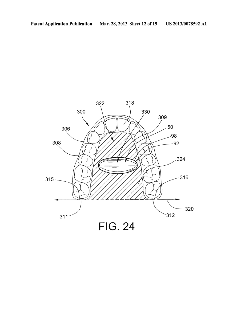 APPARATUS FOR REMOVING DENTAL APPLIANCE AND DENTAL SYSTEM - diagram, schematic, and image 13