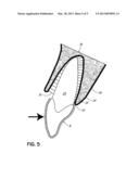 Orthodontic Appliance and Method of Orthodontic Treatment with Same diagram and image