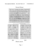 GENE EXPRESSION PROFILING OF PRIMARY BREAST CARCINOMAS USING ARRAYS OF     CANDIDATE GENES diagram and image