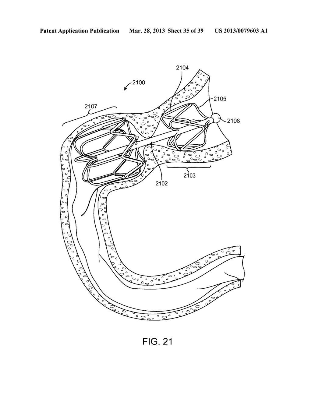 INTRAGASTRIC IMPLANT DEVICES - diagram, schematic, and image 36
