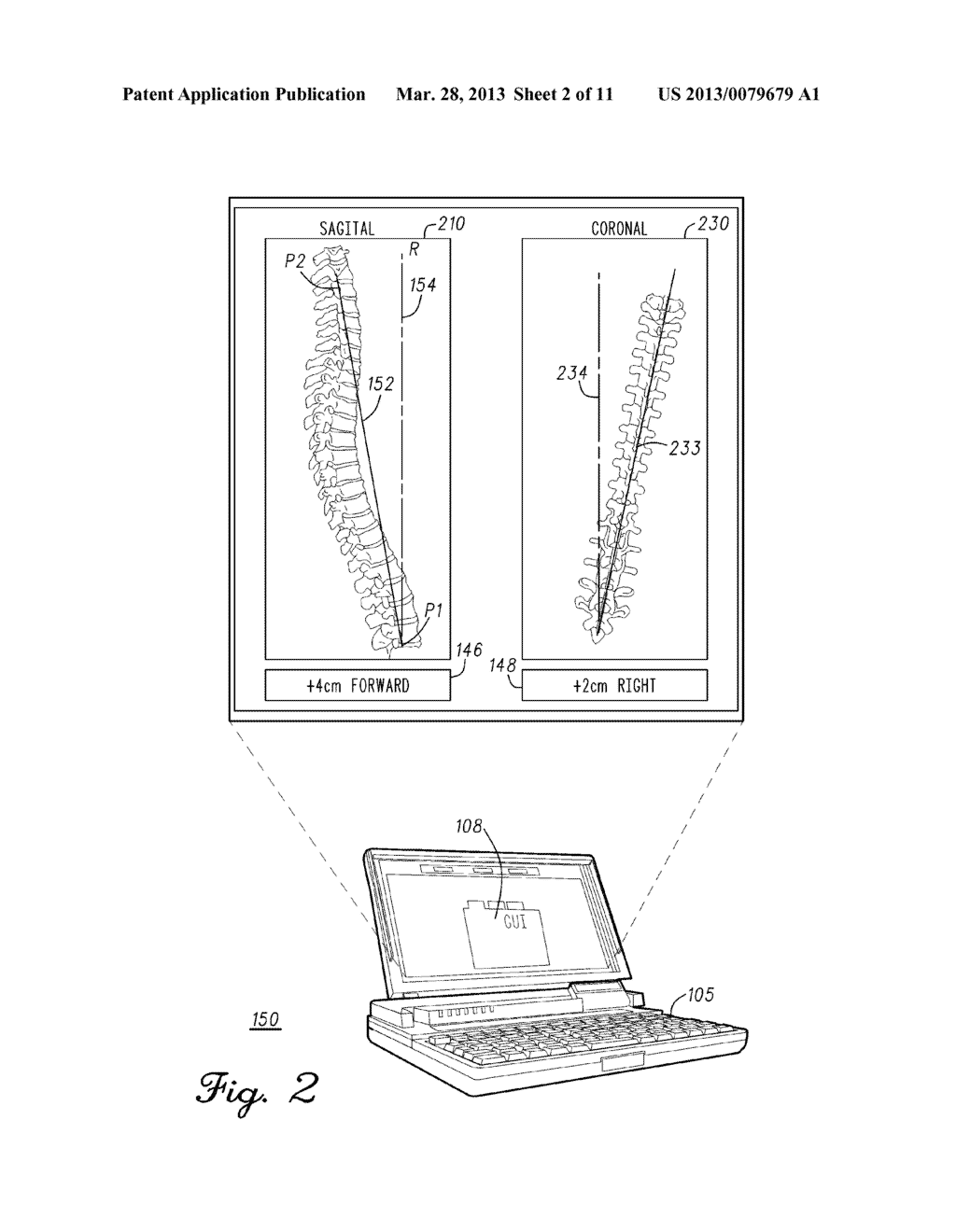 System And Method For Vertebral Load And Location Sensing - diagram, schematic, and image 03