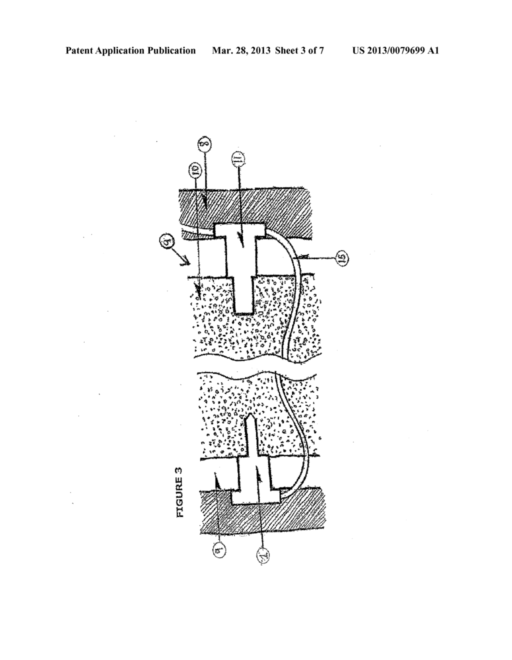 Method of draining autologous bodily fluid into intraosseus space - diagram, schematic, and image 04
