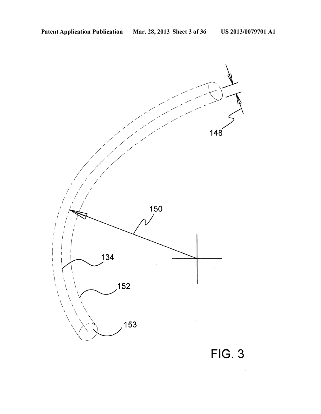 Methods and Apparatus for Delivering Ocular Implants Into the Eye - diagram, schematic, and image 04