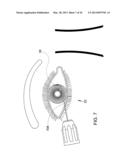 Methods and Apparatus for Delivering Ocular Implants Into the Eye diagram and image