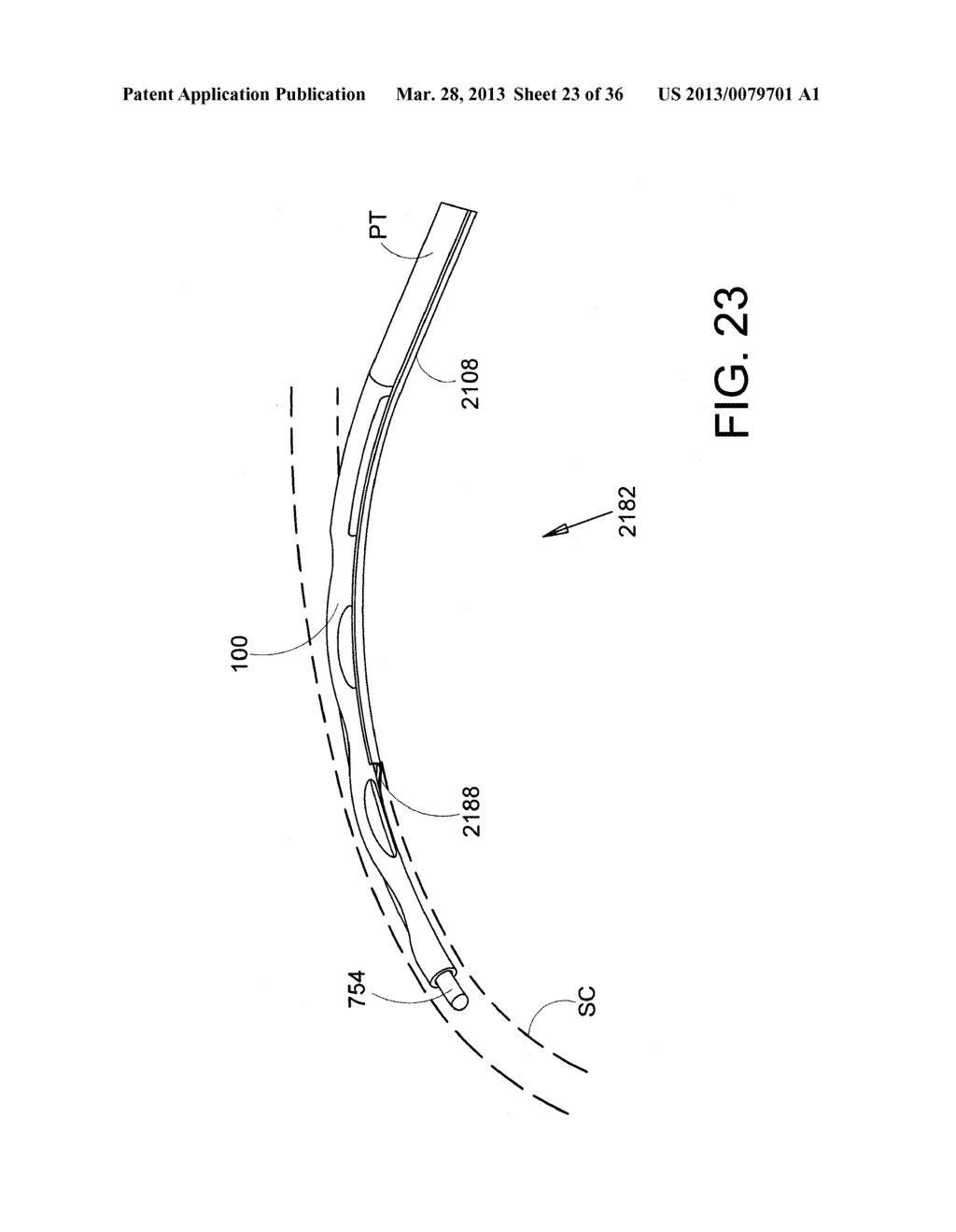 Methods and Apparatus for Delivering Ocular Implants Into the Eye - diagram, schematic, and image 24